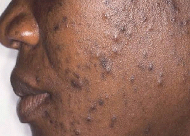 Acne skin